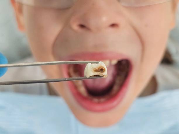 Best Knocked-Out Tooth Emergency  in Tunnel Hill, GA